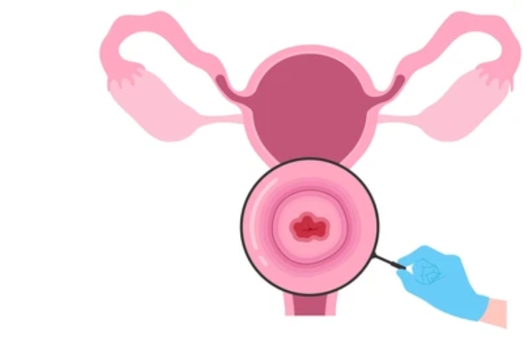 Cancer of Vulva------16