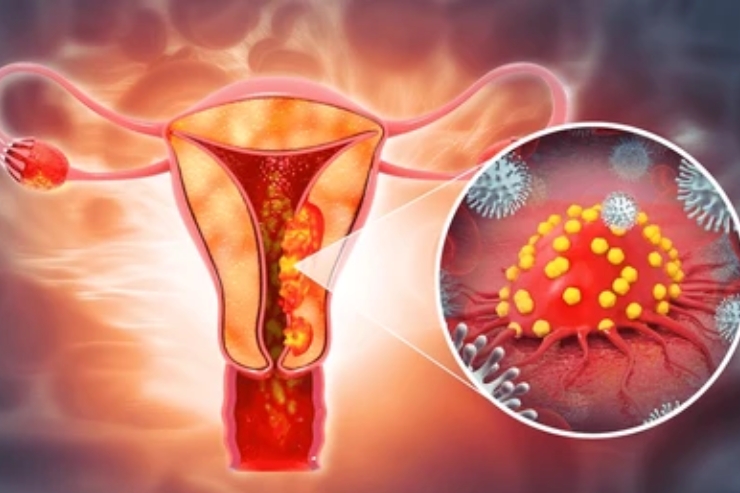 Cancer of the Endometriosis-----15