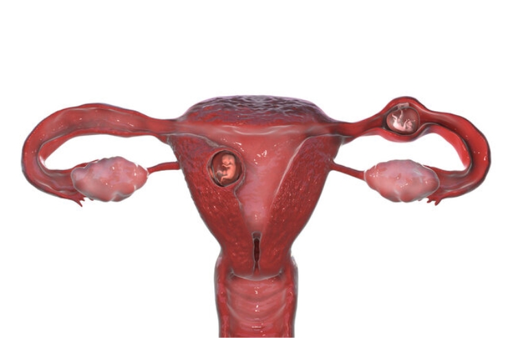 Ectopic Pregnancy