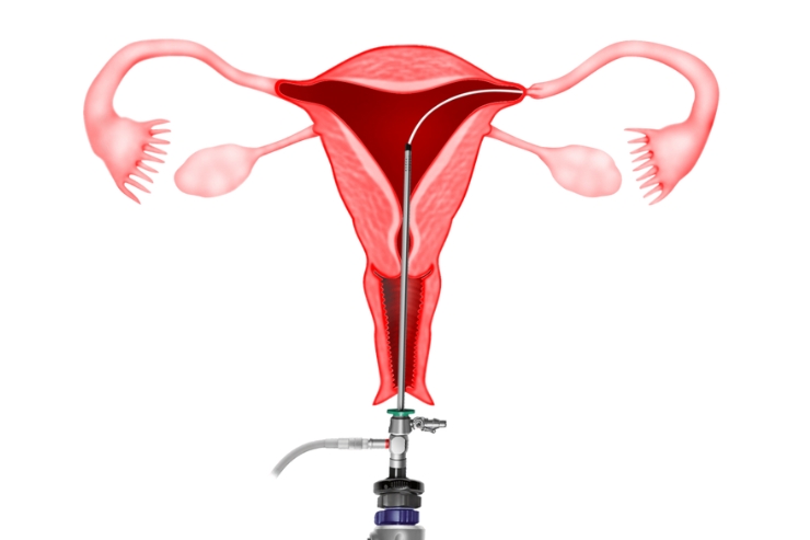 Hysteroscopic Tubal Cannulations-----14