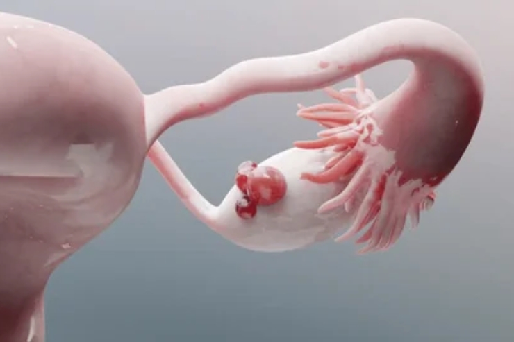 Laparoscopic Management of Ovarian Pathology