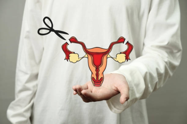 Laparoscopic Tubal Ligations