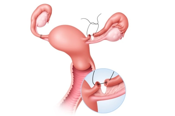 Laparoscopic Tubal Recanalisation Surgery-----13