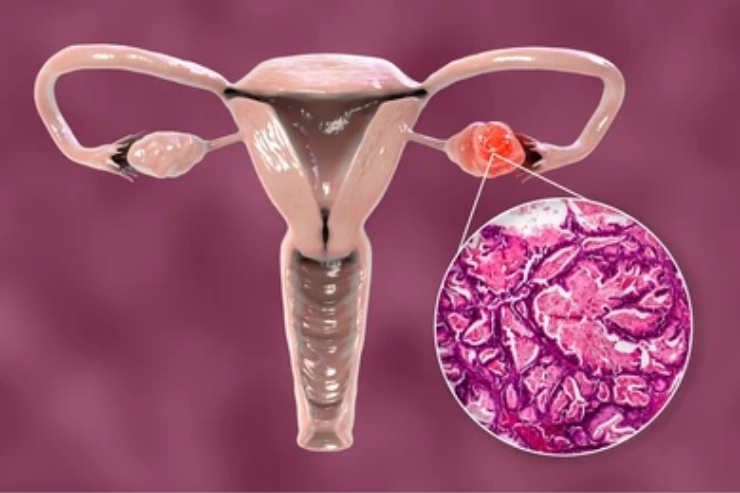 Ovarian Cancer-----15