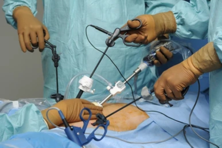 Total Laparoscopic Hysterectomy (TLH)
