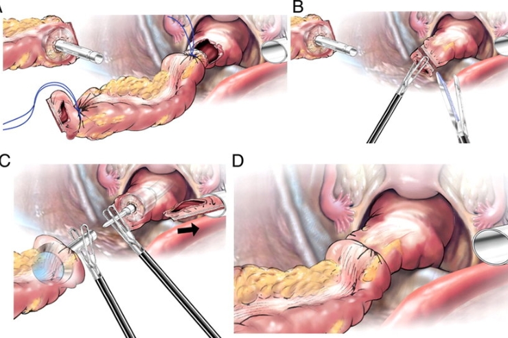 RA of Endometriosis