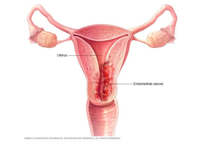 endometriosis surgery