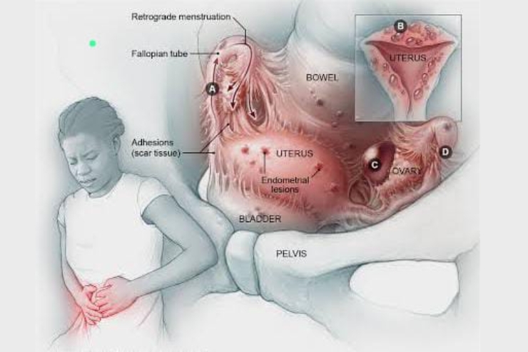 Endometriosis