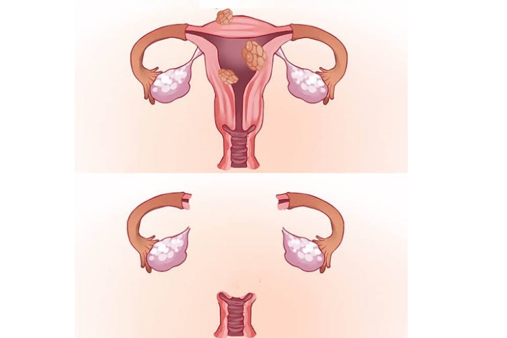 Laparoscopic Completion Hysterectomy