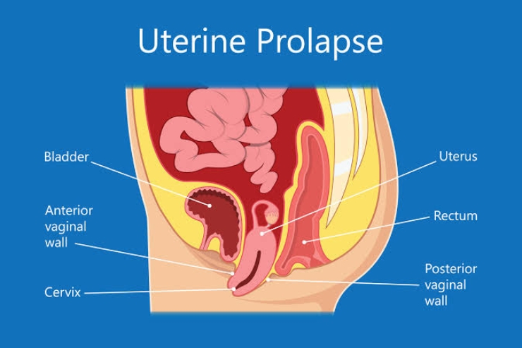 Laparoscopic Surgery for Prolapse