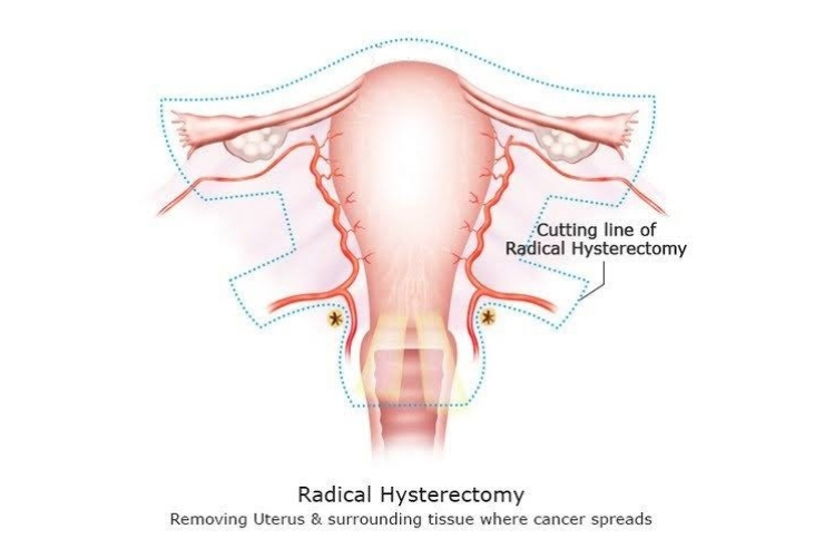  Laparoscopic Wertheim's Hysterectomy