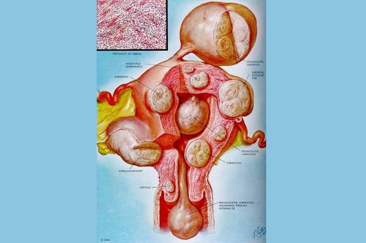 Laparoscopic Myomectomy