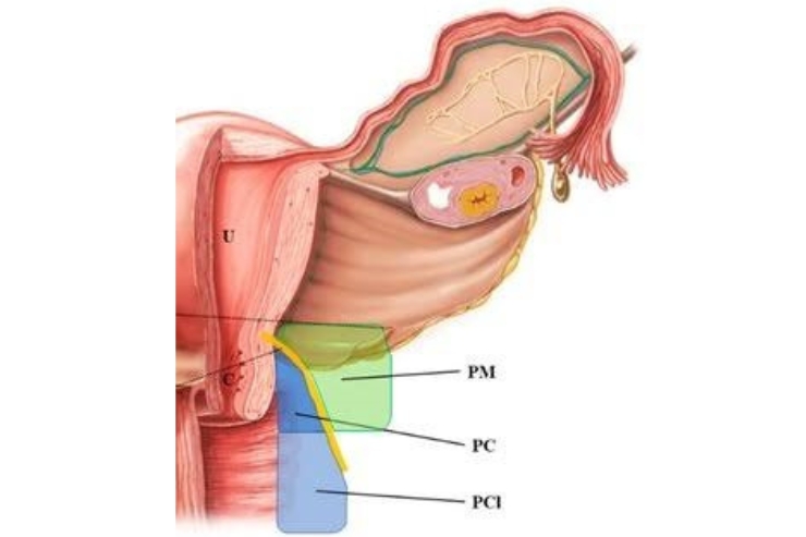 Paramectomy Surgery